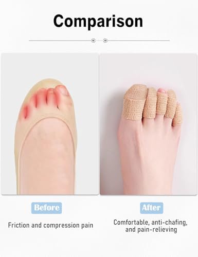 Fizzest breathable toe caps applied to a foot for pain relief.