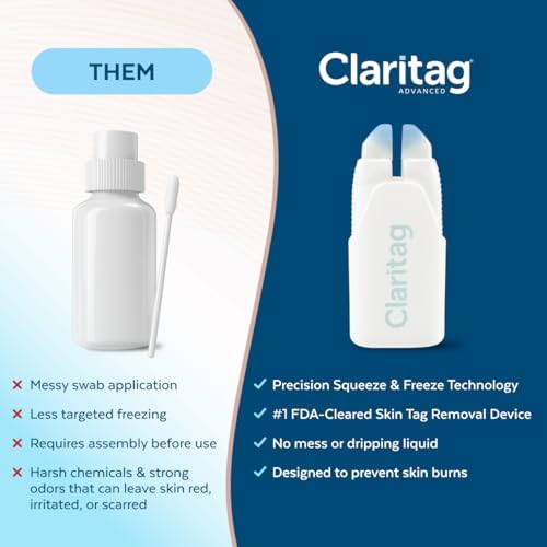 Before and after illustration of skin tag removal using the Claritag cryogenic treatment.