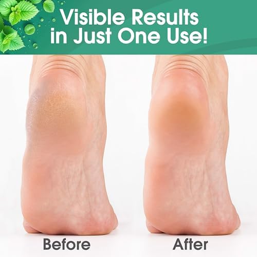 DeEnti cool mint callus remover gel bottle with precision applicator.