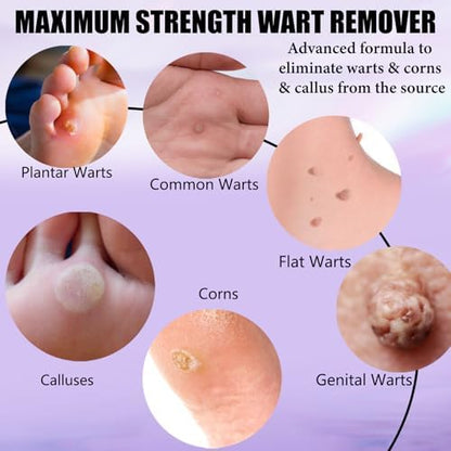 Liquid wart remover application on a common wart for fast acting results.