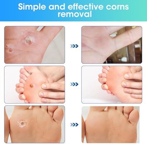 Step by step application diagram for applying salicylic acid corn removal patches onto a toe.