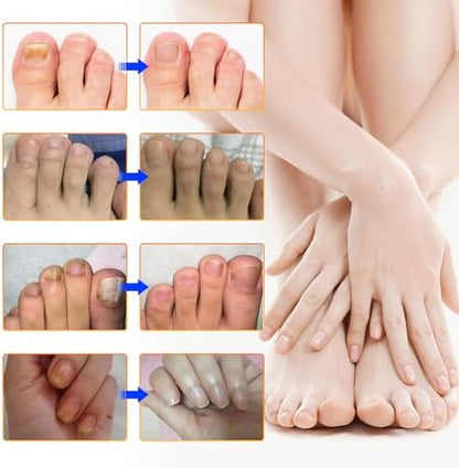 Minleer Toenail Treatment box showing 32 patches count