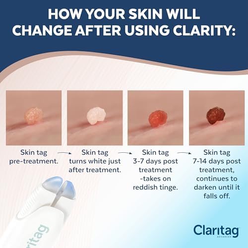 The contents of the Claritag 10 treatment cycle kit including the pre-loaded cryogenic device.