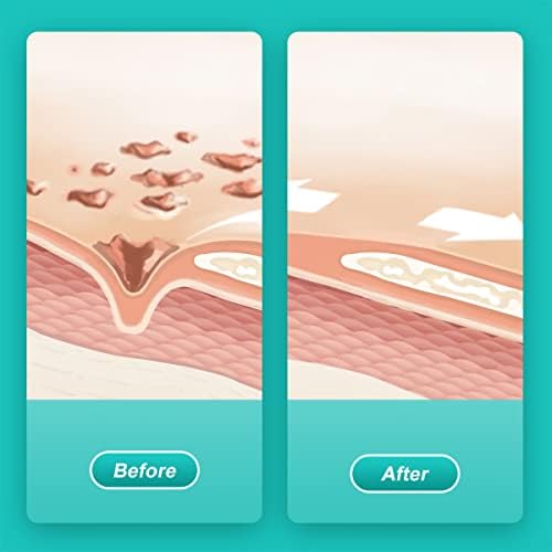 Hydrating hydrogel wound dressing for autolytic debridement and necrotic tissue removal.