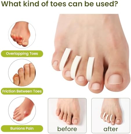 Bukihome foam spacers placed between toes demonstrating alignment correction for overlapping toes.
