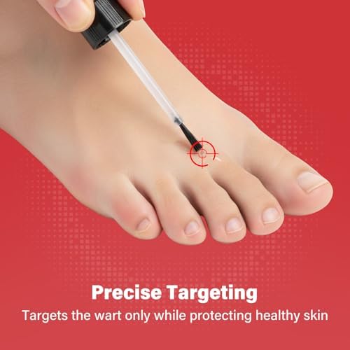 Applying Goodnites liquid wart remover to affected foot area.