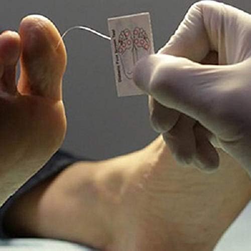 Disposable 10g monofilament filaments for professional sensory nerve function screening.