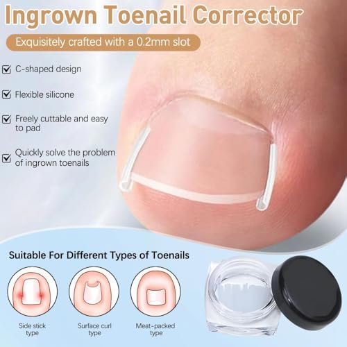 Demonstration of applying the C shape correction patch to the toenail