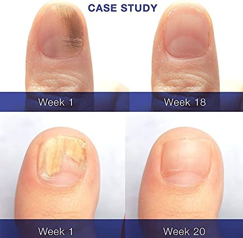 Authentic USA imported Dr. Luke nail and cuticle care for fungus.