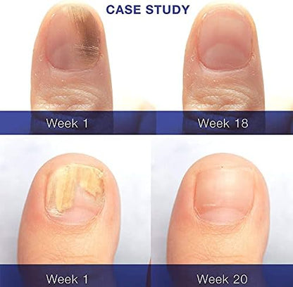 Authentic USA imported Dr. Luke nail and cuticle care for fungus.