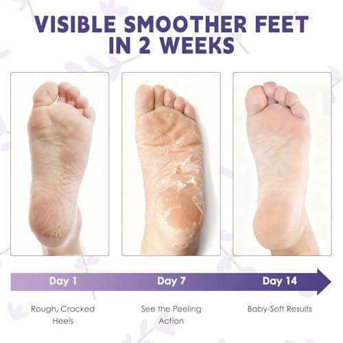 Before and after comparison of dry cracked heels treatment using the mask