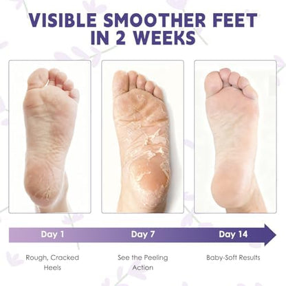 Before and after comparison of dry cracked heels treatment using the mask