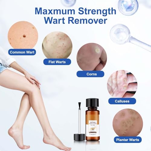 TZEP wart remover packaging showing bee venom and salicylic acid ingredients.