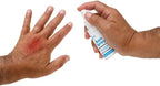 Globe topical anesthetic burn spray for minor scalds and scrapes application