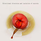 Pack of 20 pieces SLFJOSN customizable skin barrier rings for leak prevention
