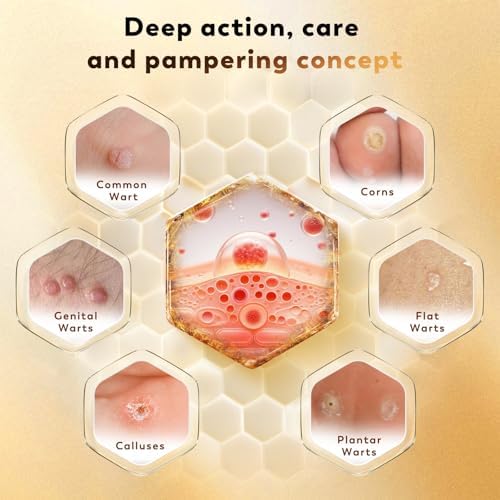 Zozdal Bee Venom fast acting formula showing 30ml bottle for common wart care.