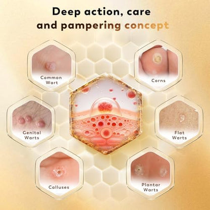 Zozdal Bee Venom fast acting formula showing 30ml bottle for common wart care.