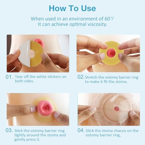 Demonstration of the moldable and stretchable properties of the TNTNDAY ostomy ring.