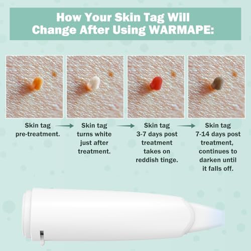 WARMAPE kit showing ten treatments for neck and body skin tags