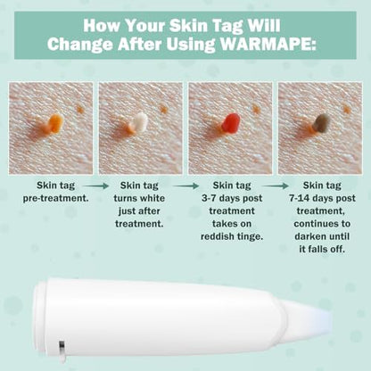 WARMAPE kit showing ten treatments for neck and body skin tags