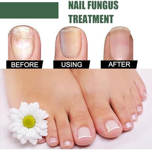 Top view of nail fungus treatment dropper bottle