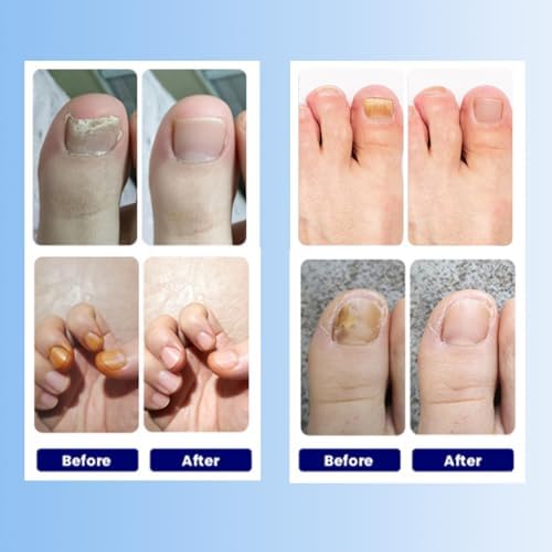 Funga Patch 8-hour firm adhesion technology demonstration on a fingernail