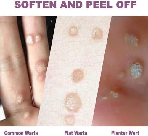 Maximum strength salicylic acid gel for plantar and common wart removal packaging.