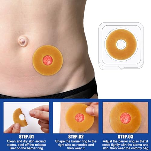 Siifert latex free stoma extender rings arranged inside their protective plastic storage case