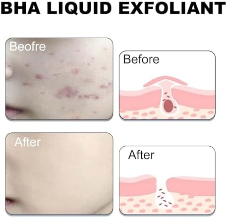 Paula's Choice BHA exfoliant application with cotton pad