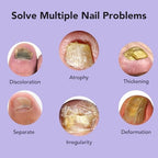 Applying Ourui One extra strength drops to a discolored toenail