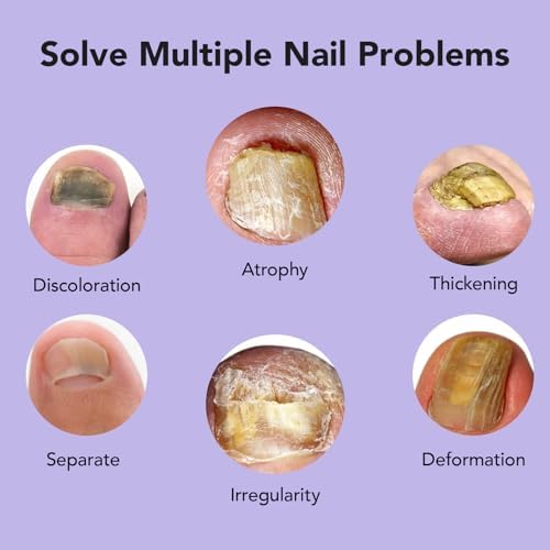 Applying Ourui One extra strength drops to a discolored toenail