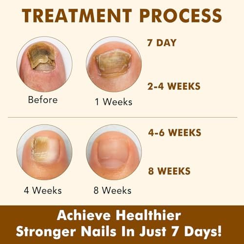 Ginger essence nail repair oil providing assistance with restoring damaged nail plates
