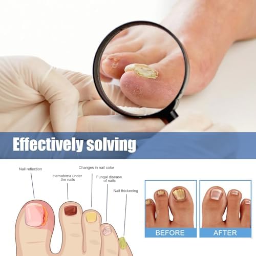 Extra strength hydrogel nail repair stickers for discoloration.
