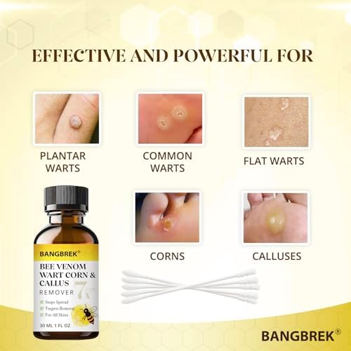 Bee venom boosted formula for plantar wart and corn removal