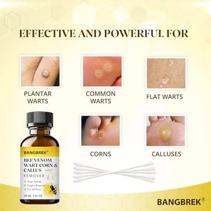 Bee venom boosted formula for plantar wart and corn removal