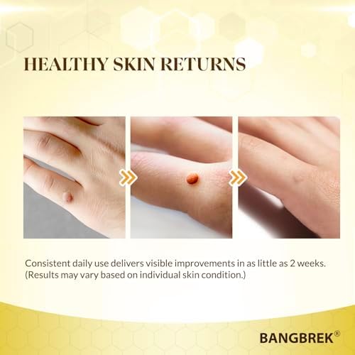Bangbrek foot care treatment for stubborn calluses and flat warts