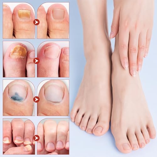 Generic extra strength toenail treatment lifestyle usage packaging