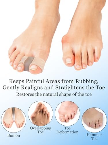PGRODE gel toe spacers applied to feet demonstrating proper alignment between the big toe and second toe.