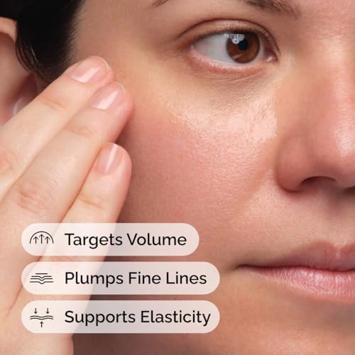 Under-eye treatment targeting hollow sunken areas with Volufiline