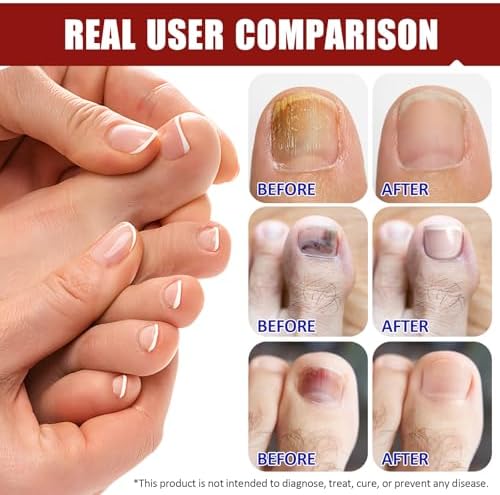 Lifestyle shot of the discreet skin toned nail patches worn on the toes during sleep.