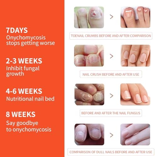 Comparison of thickened nail before and after using extra strength renewal patches.