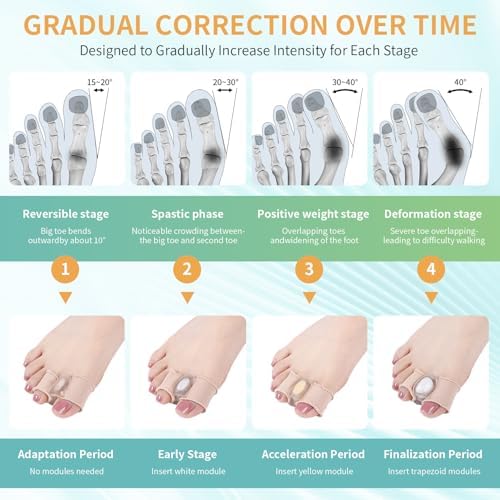 Pitoyteck Bunion Corrector showing the dual loop design secured on human toes for alignment.