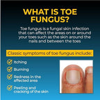 Fungi-Nail liquid solution application on skin around the toe area