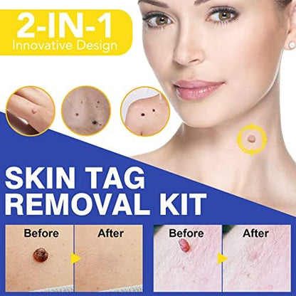 SHISUIZHE Skin Tag Removal Kit contents including swabs and micro bands.