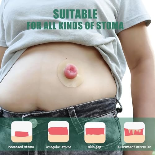 Authentic USA imported medical ostomy supplies displayed to showcase the moisture absorbing skin friendly barrier rings.