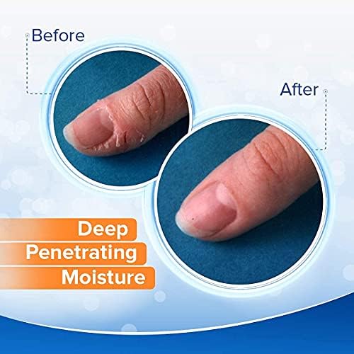 Applying Dermal Therapy hydrating cream to dry cracked fingertips