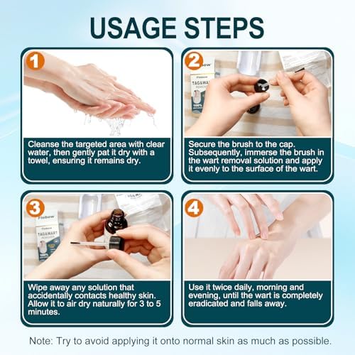 Compound W liquid gel applied to a common wart for fast-acting at home removal