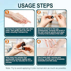 Compound W liquid gel applied to a common wart for fast-acting at home removal