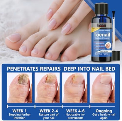 Professional nail fungus repair solution for healthy nail growth