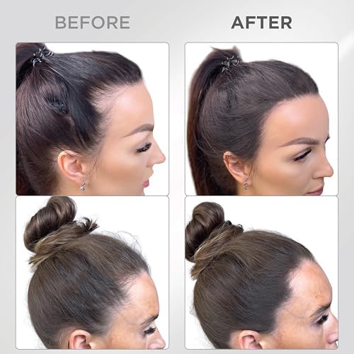 Model demonstrating Thick Fiber hair thinning coverage application